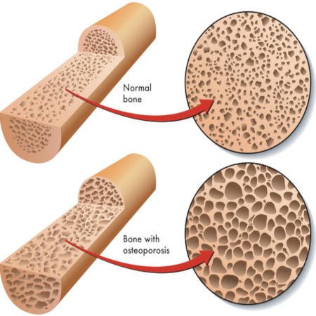 Can wrinkles predict bone health in women? - Cool-jams
